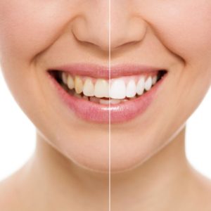 Before & After Teeth Whitening at The Super Dentists