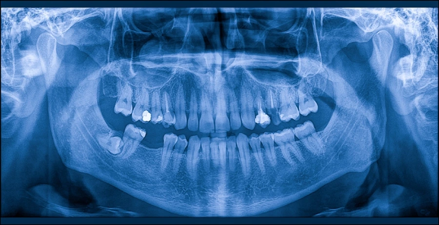 Wisdom tooth on dental xray