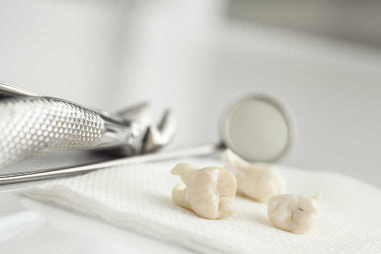 Wisdom Teeth: Everything You Need to Know