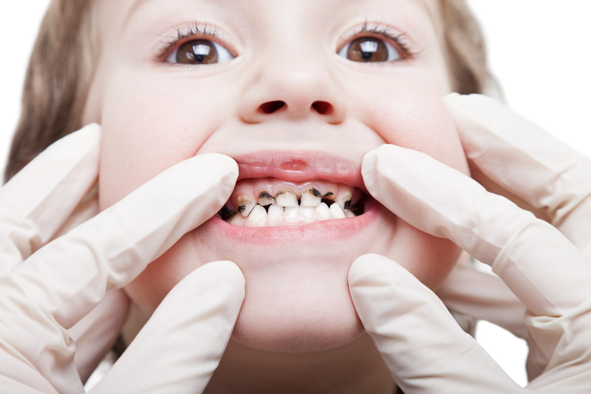 Pediatric Dentist Showing Early Stage Tooth Decay in Child's Front Teeth - The Super Dentists