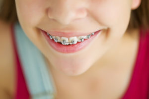Young Girl Smiling Wearing Braces Showing only Bottom Half of Face - The Super Dentists