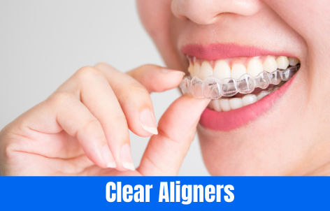 Clear Aligners at The Super Dentists in San Diego