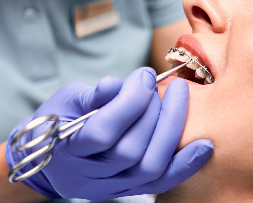 Closeup of dentist inserting braces