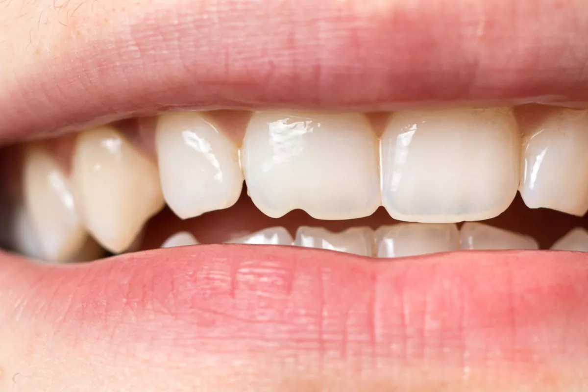 Close up of Mouth with Chipped Front Teeth - The Super Dentists