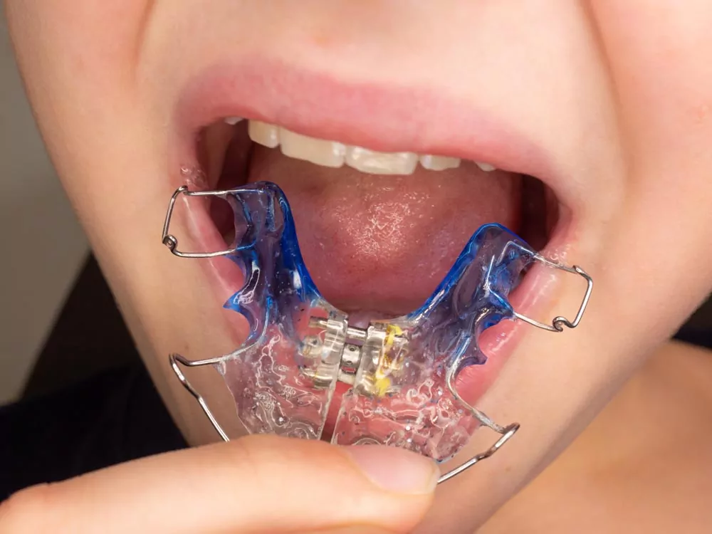 Understanding The Importance of Retainers After Braces