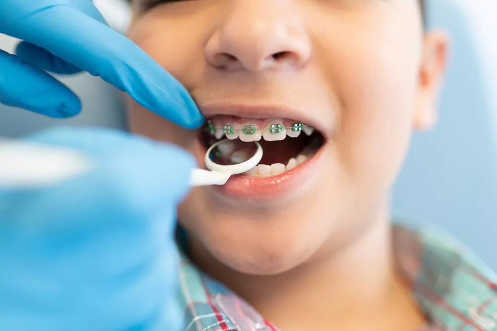 9 Soft Snacks for Kids with Braces | The Super Dentists
