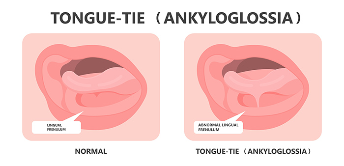 What a tongue tie looks like