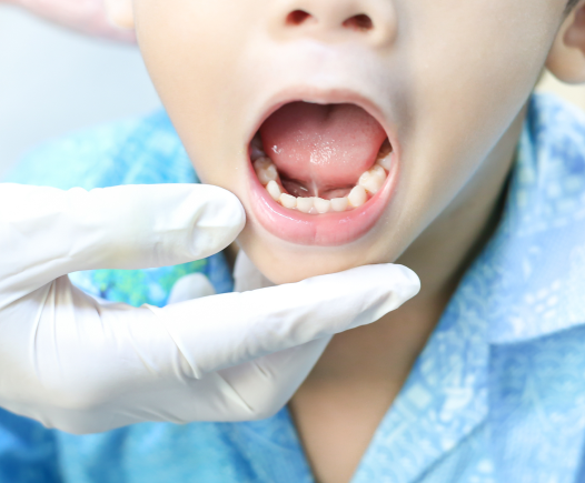 kid having Ankyloglossia condition - The Super dentist