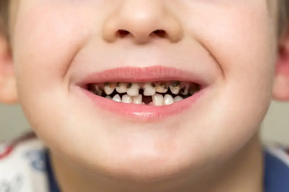 Child with cavities