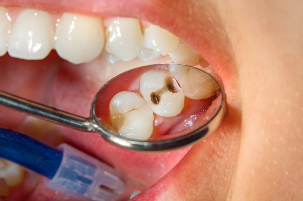 Cavities in teeth
