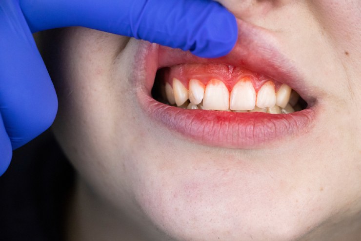 Gingivitis in gums
