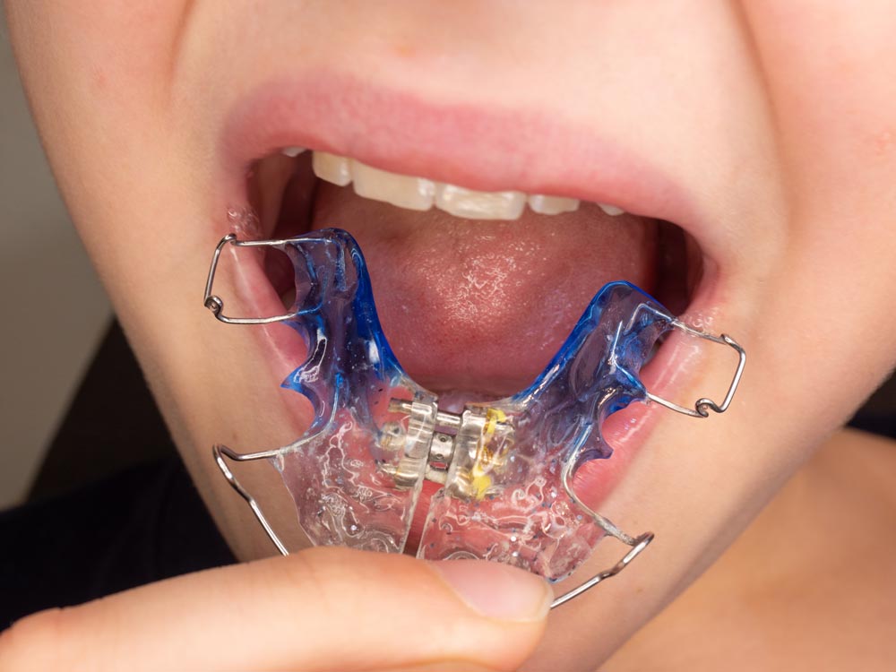 Retainers After Braces: Here’s Why Wearing Your Retainer is So Important
