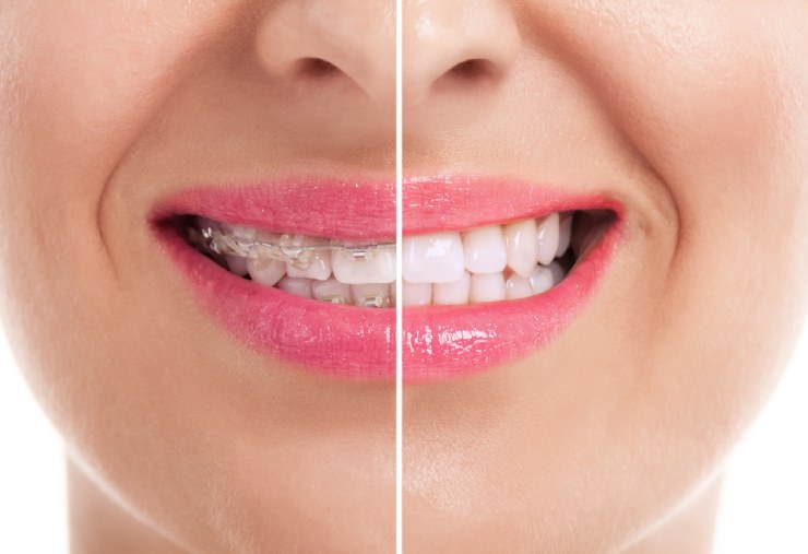 Woman before and after braces