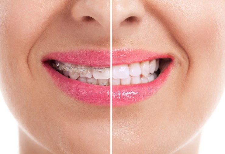 Close Up of Woman's Teeth Showing Half Braces Have Straight Teeth After Braces - The Super Dentists