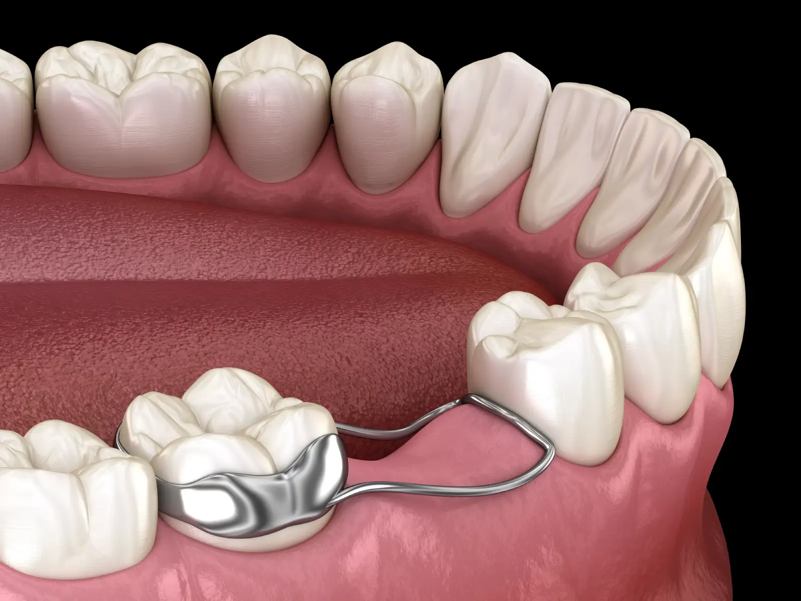 Bottom Row of Teeth Showing Dental Space Maintainer in Place of Primary Tooth - The Super Dentists