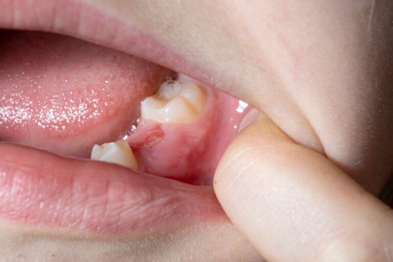 Child with an exposed molar