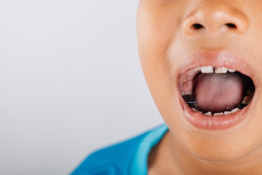 Child with silver teeth in their mouth
