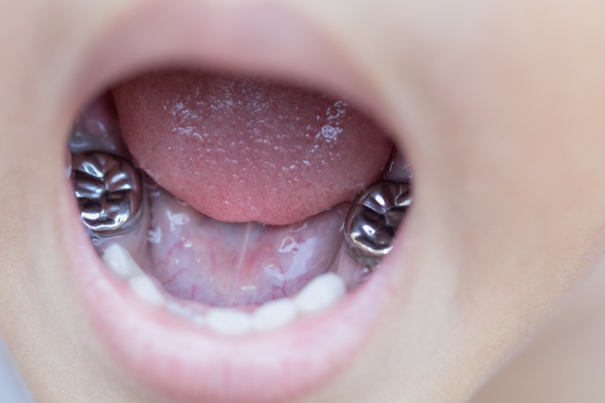 Silver teeth in childs mouth