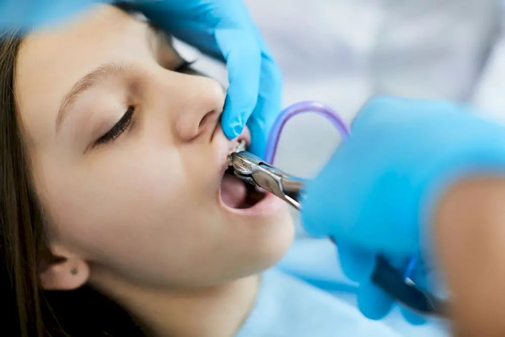 Close up of young girl getting teeth braces removed 