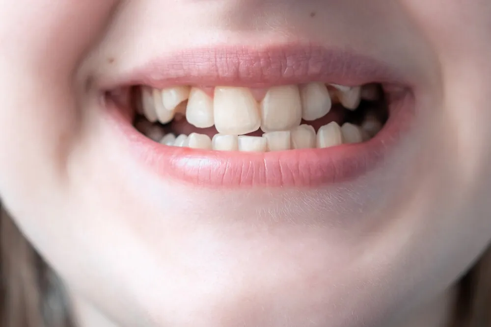 Close-up of young woman’s face with crooked teeth indicating the need for braces