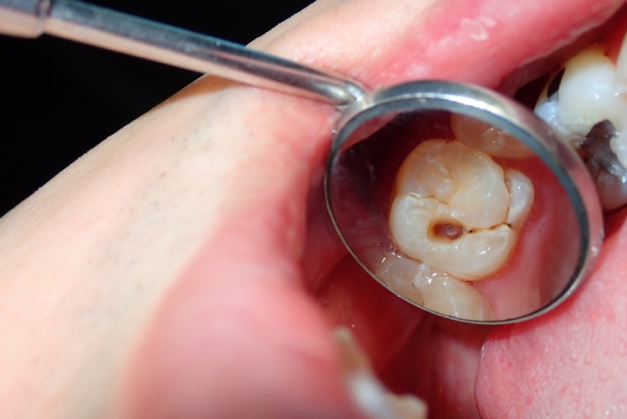 Tooth decay in child’s mouth