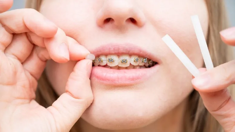 Young woman with braces applies orthodontic wax.