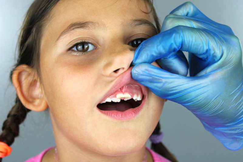 Young girl with “shark teeth” on top row of teeth