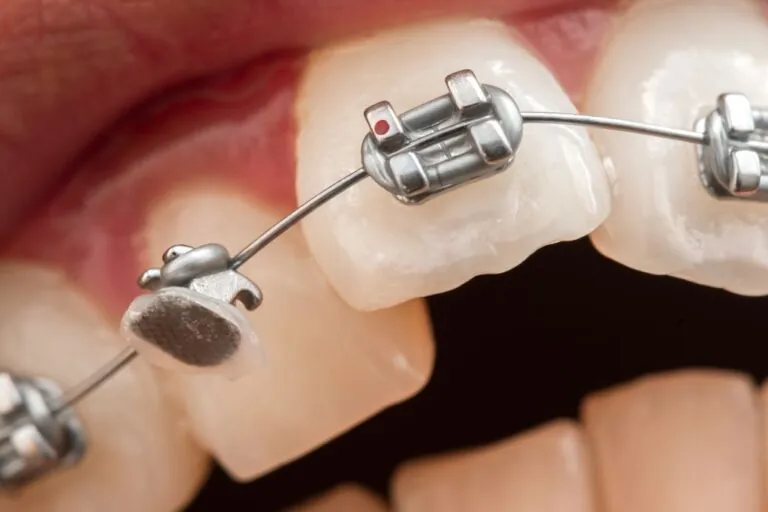 Broken braces bracket/bracket that has come unglued from the tooth