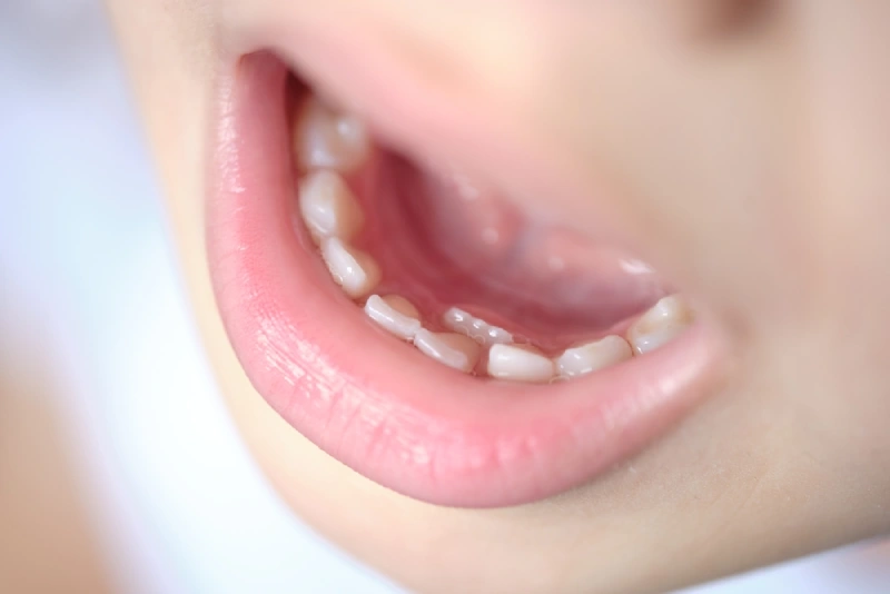 What Are Shark Teeth in Kids? Parents, Here’s What to Know