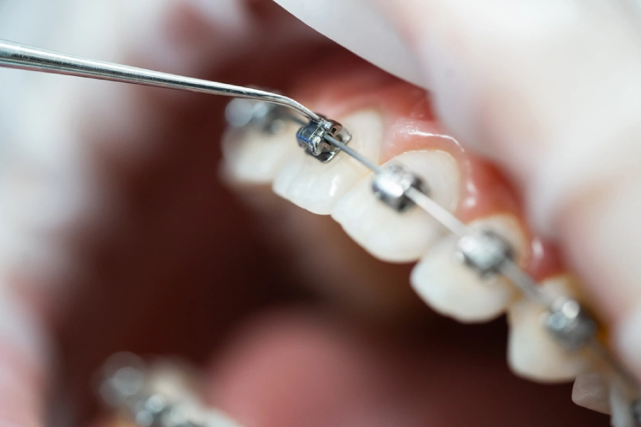 Close-up of braces tightening