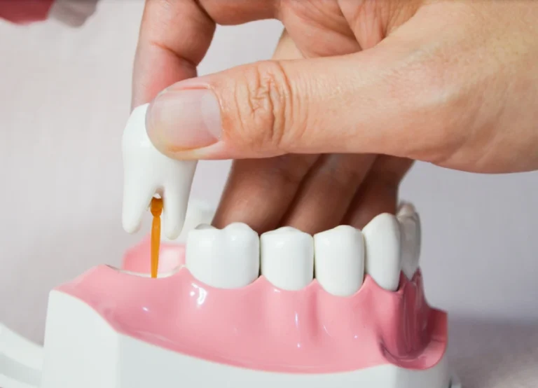 Hand extracts a wisdom tooth on a plastic diagram of the human mouth