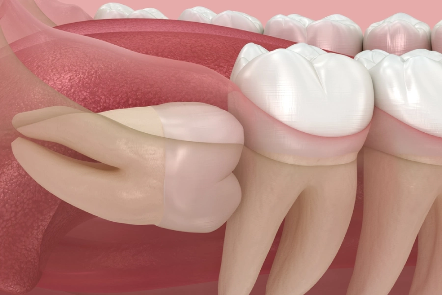 A medically accurate 3D depiction of impacted wisdom teeth symptoms, showing the inside of a jaw bone with an impacted wisdom tooth sideways inside the bone, pushing and crowding other molars.