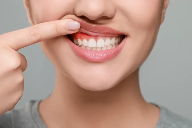 View of a woman’s gums with the left half showing redness and inflammation consistent with gingivitis and the right half showing only healthy gums