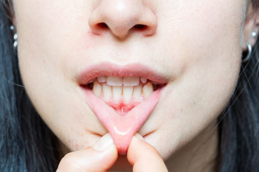Woman experiences receding gums