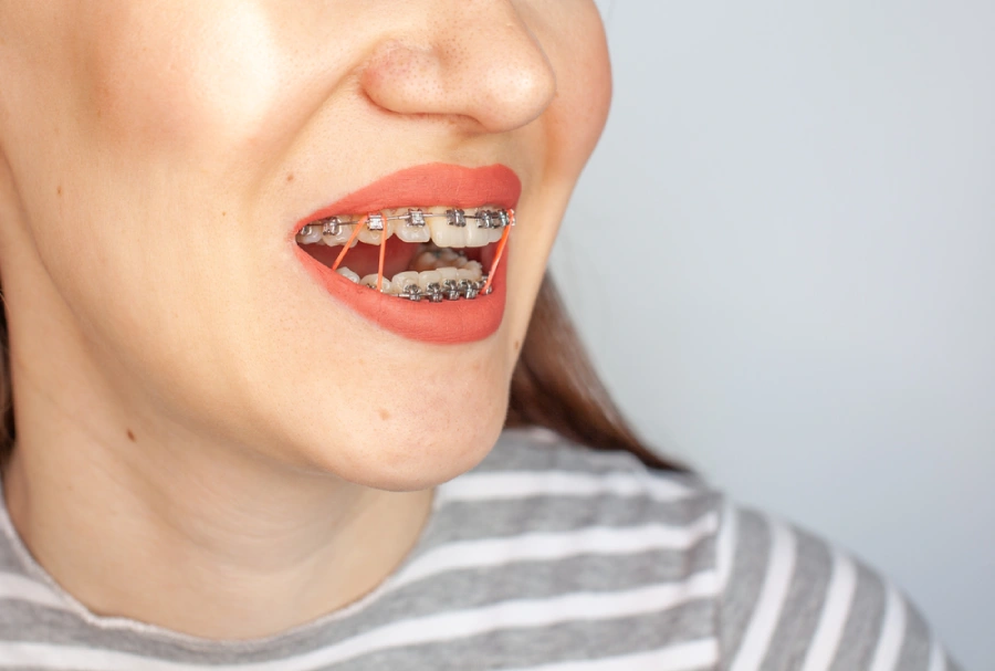 The Importance of Braces Elastics