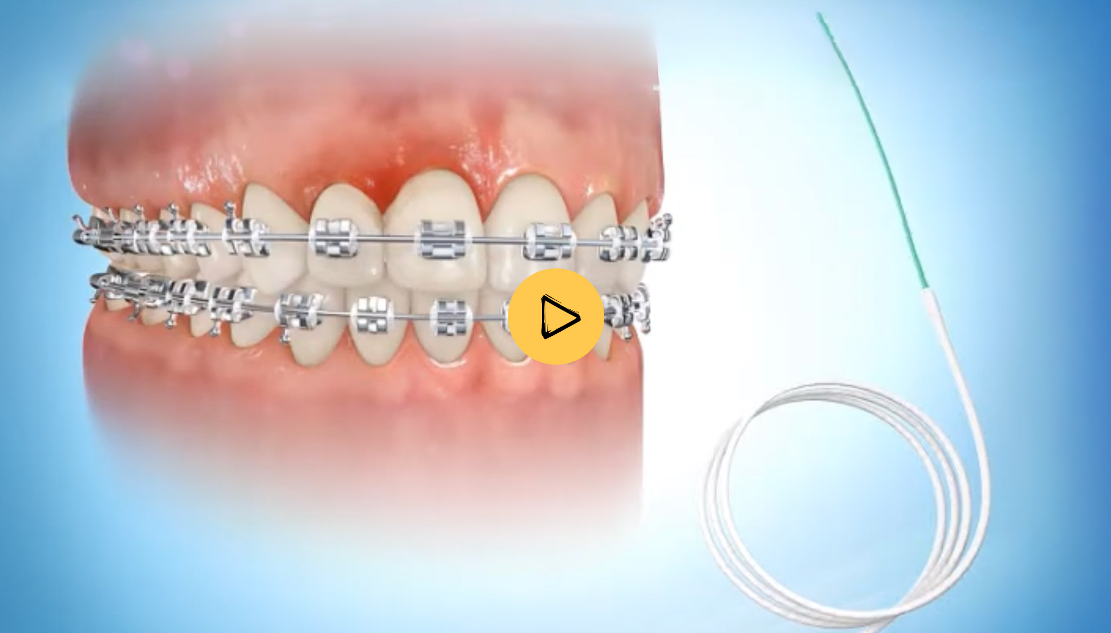 Flossing with Superfloss