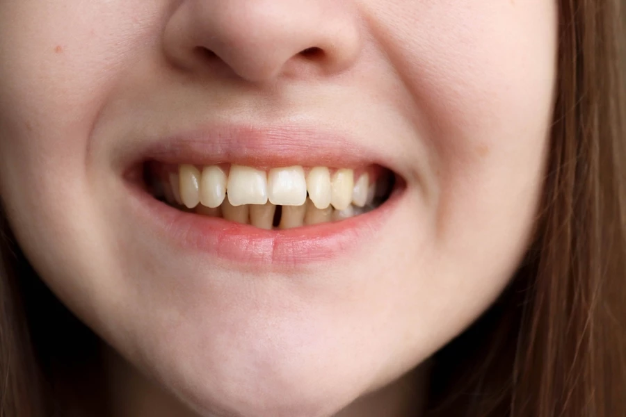 Close-up of a young girl who exhibits an overbite and may need braces