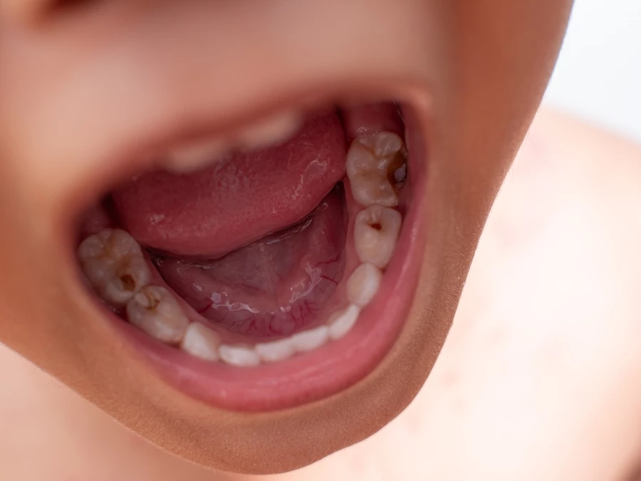 Child’s mouth with cavities shown in bottom teeth