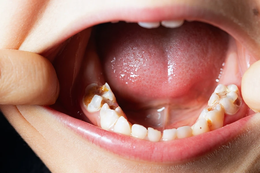 Close-up of child’s mouth containing multiple cavities
