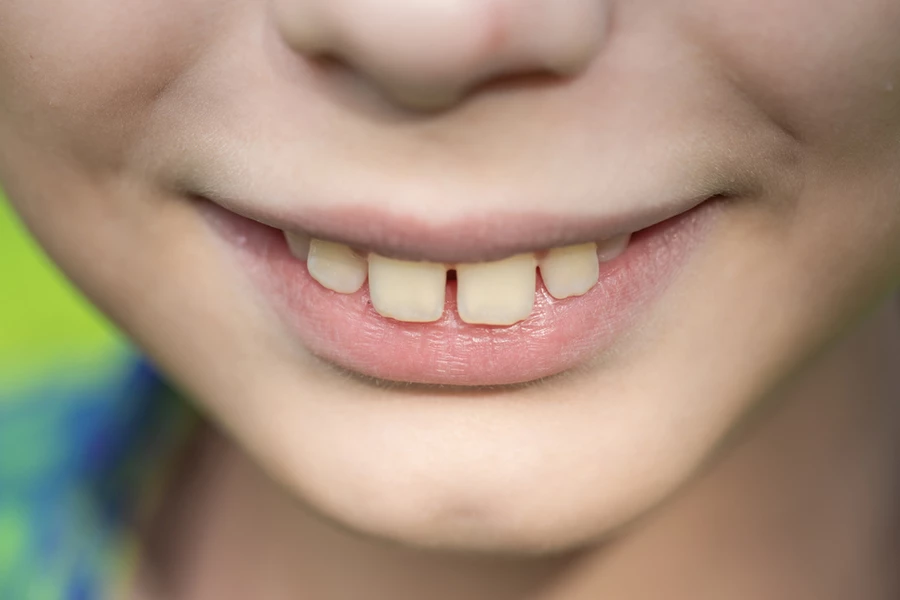 Young boy with an overbite