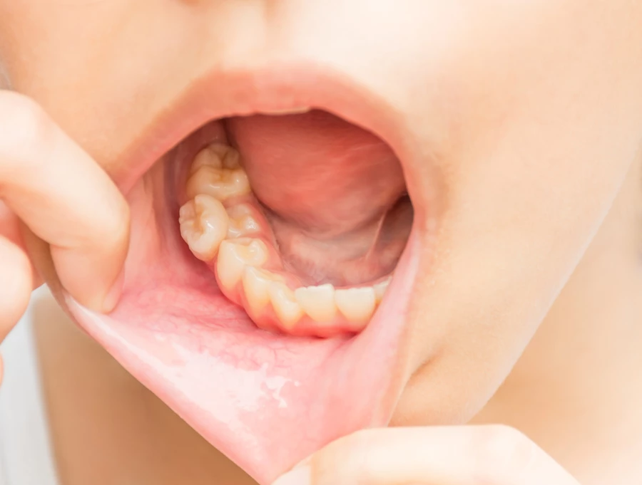 Crowded baby teeth