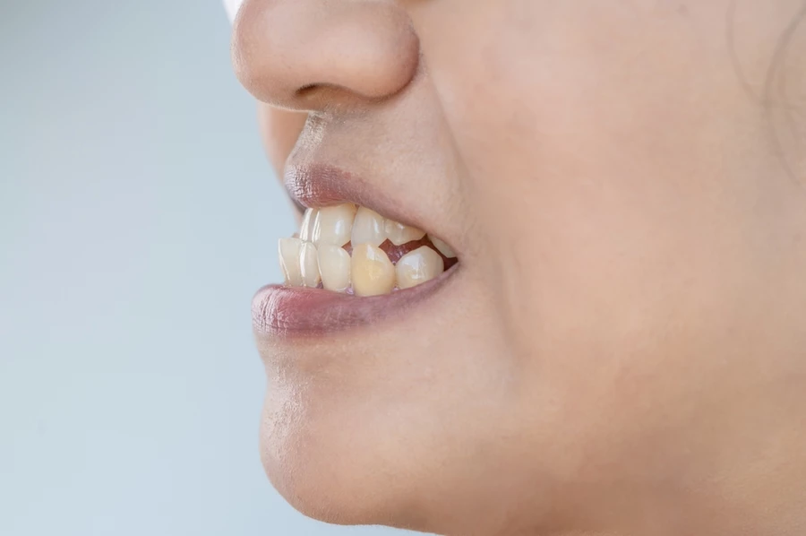 Underbite