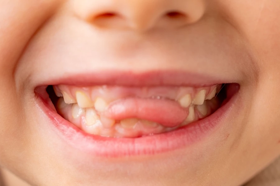 Tongue thrust in a baby