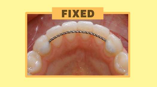 Fixed/Permanent Retainers - The Super Dentists
