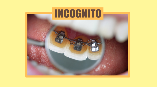 Pros and Cons of Incognito or Hidden Braces - The Super Dentists