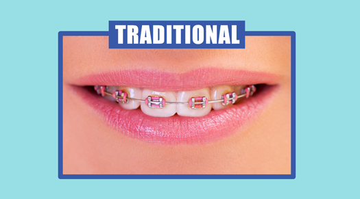 Pros and Cons of Traditional Braces - The Super Dentists