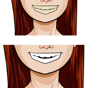 Animated Graphic of Teeth Whitening Before & After - The Super Dentists