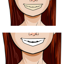 zoom-whitening-03 teeth whitening options